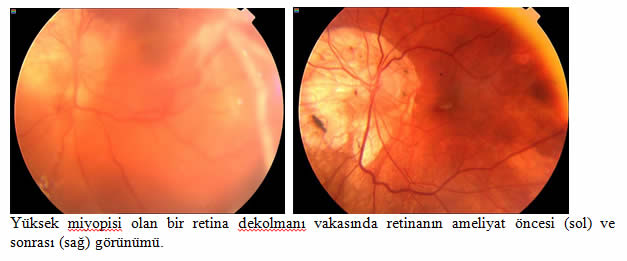 retina_dekolmani6