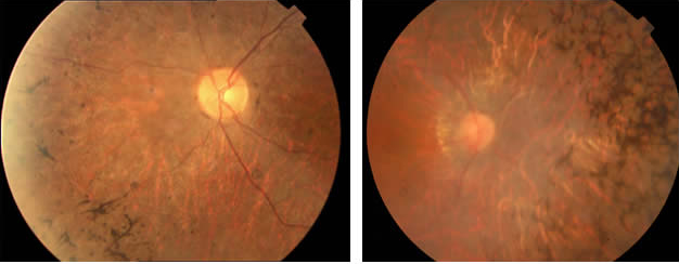 retinis