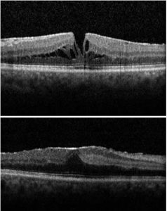 optik-koherens-tomografi-oct-ankarada-retina-doktoru