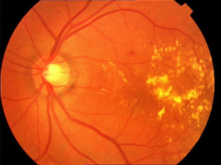 Макулопатия глаза. Диабетическая ретинопатия. Токсическая ретинопатия. Диабетическая ретинопатия офтальмоскопия. Гипертоническая ретинопатия.